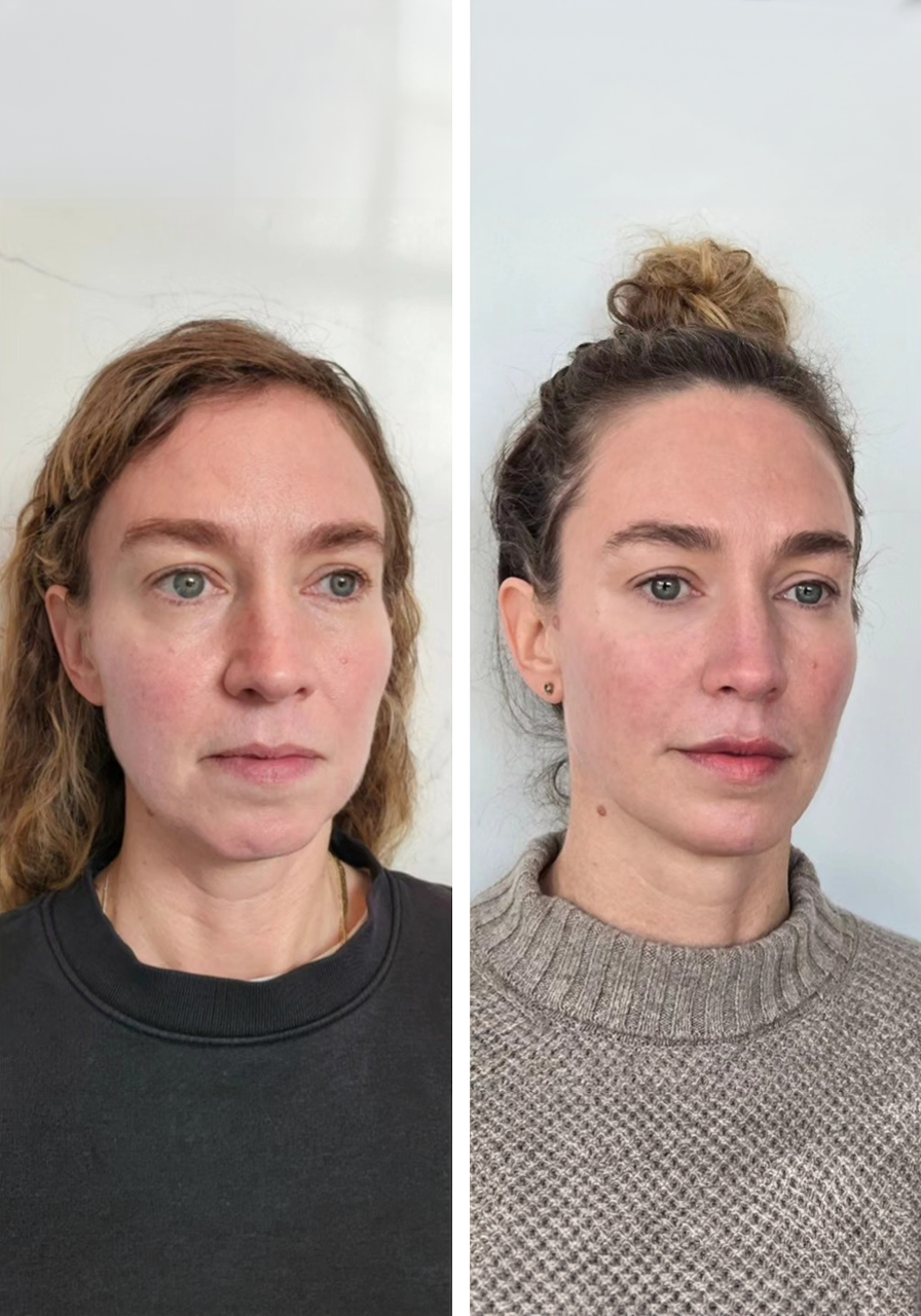 Side-by-side comparison of a woman before (left) and after (right) skincare or cosmetic treatment, showing clearer, smoother skin and slight makeup in the after photo.