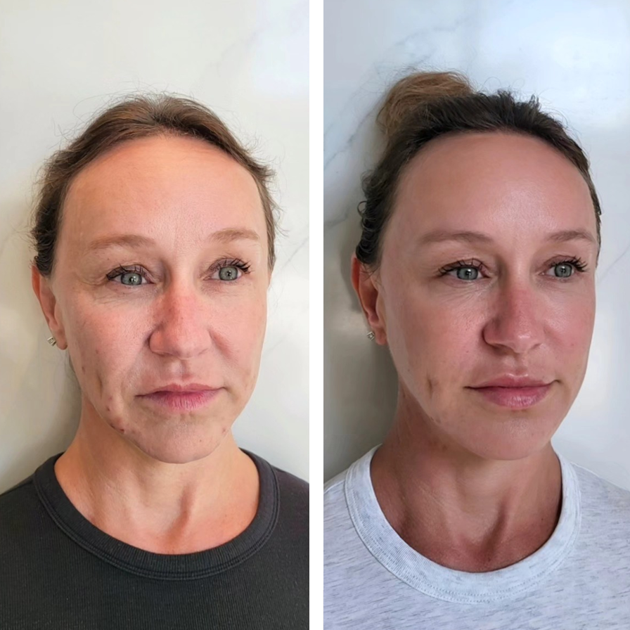 Side-by-side comparison of a woman before and after facial treatment, showing improved skin condition and smoother complexion.