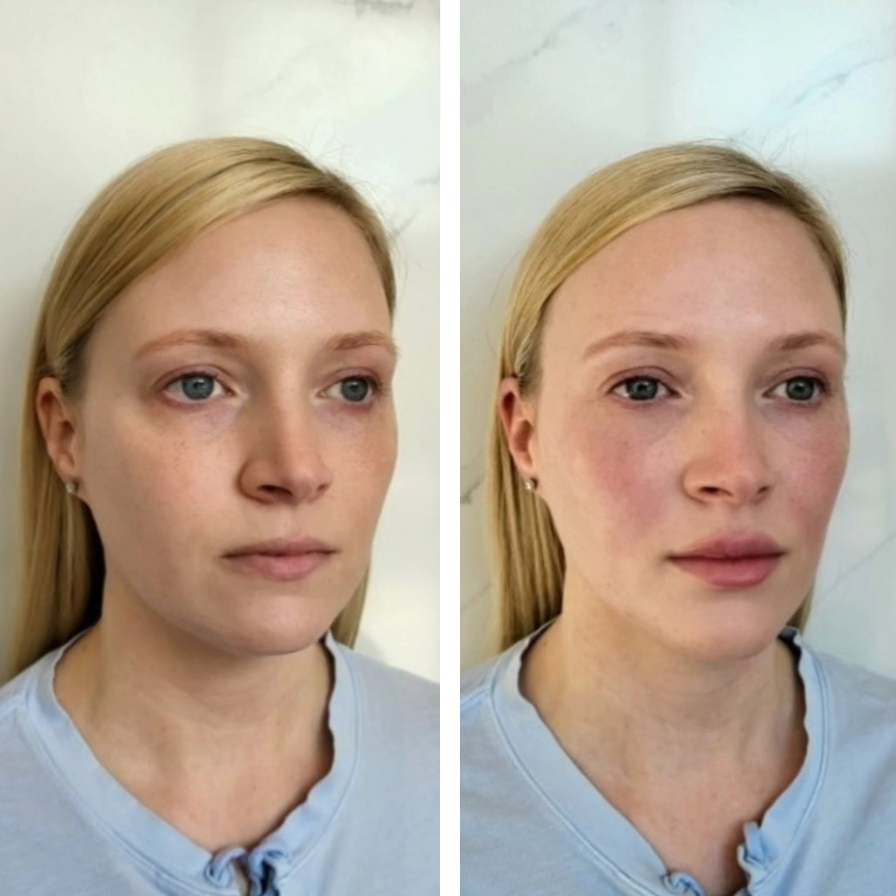 Before and after photos of a woman with fair skin and blonde hair, showing facial changes.