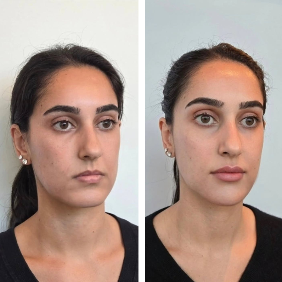 Comparison of a woman's face before and after skincare treatment, showing clearer and smoother skin in the second image.