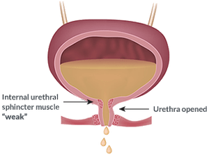 Bulkamid Treatment | Discover Bladder Control Solutions Today — Boston