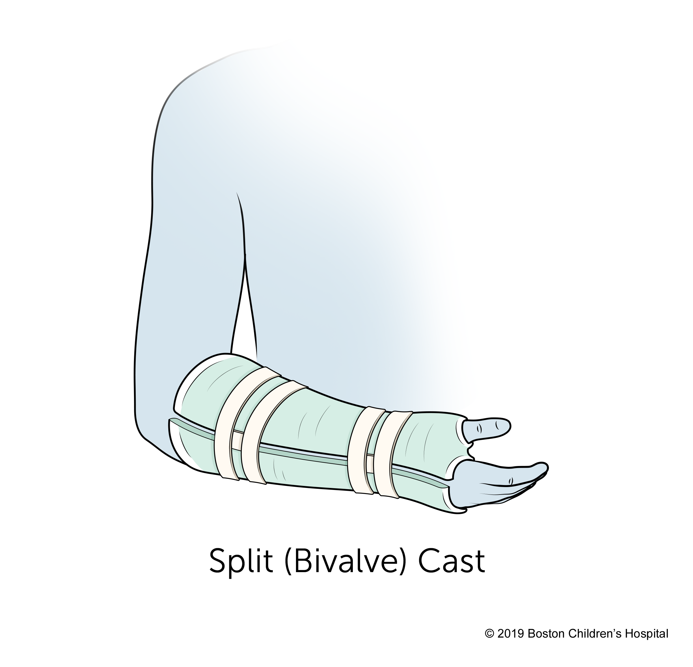 ActivArmor 3D Printed Casts Accommodates For Edema Swelling ActivArmor activarmor-3d-printed-casts-accommodates-for-edema-swelling-activarmor