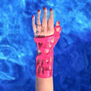 For Patients | ActivArmor | Custom 3D Printed Casts and Splints