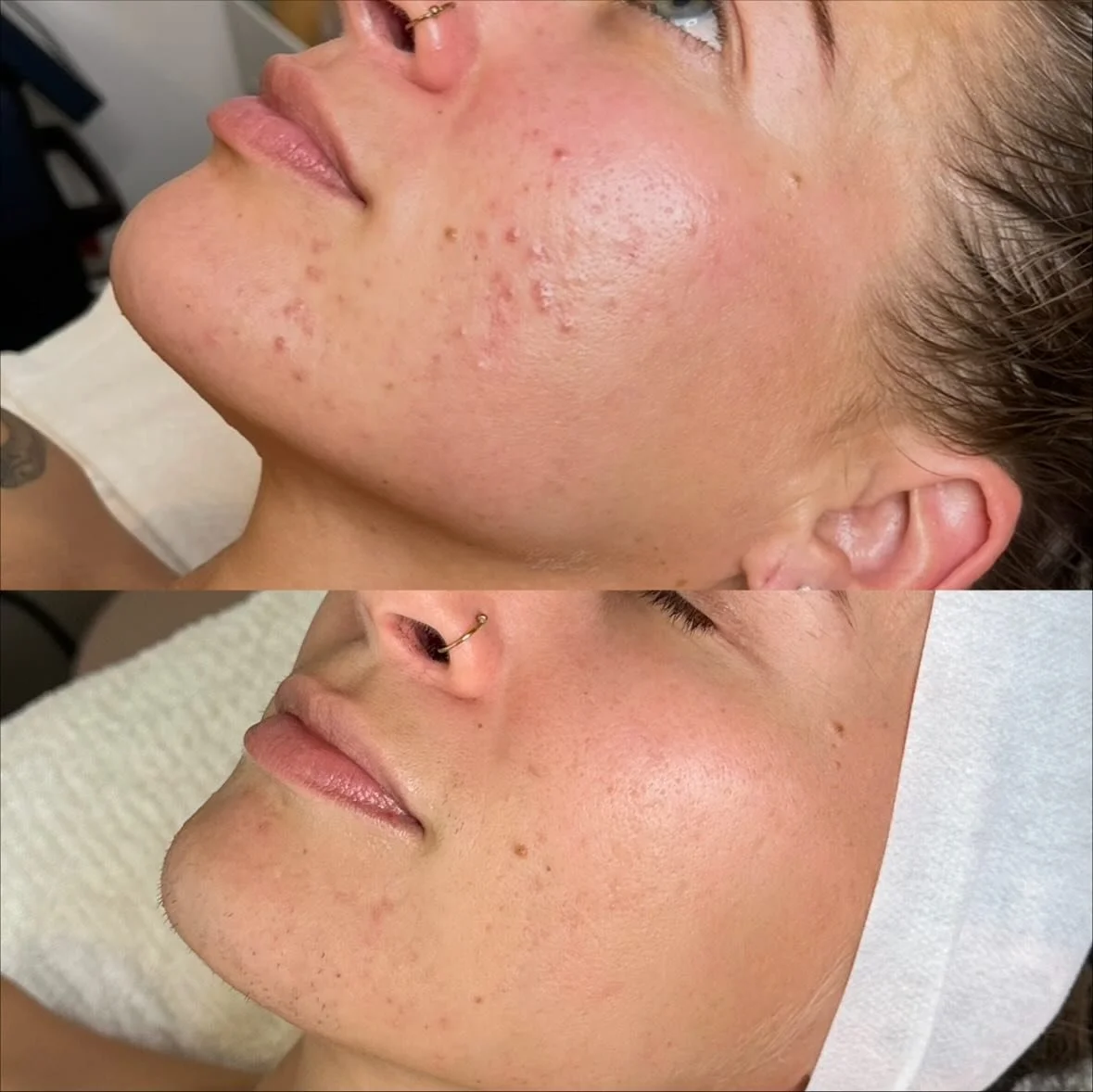 The best part of skin transformations is always hearing how positive the effects have had on how a person feels about themselves. When they speak about how happy they are with their skin, being able to leave the house without makeup, no longer feelin