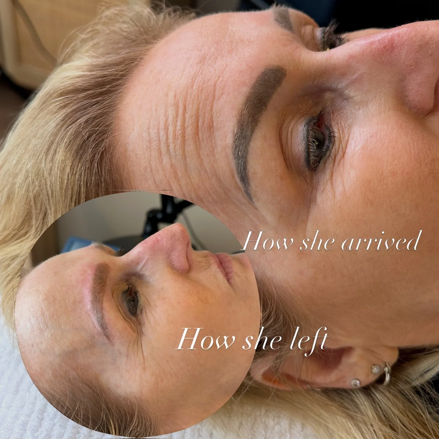 The journey of cosmetic tattoo removal. Client arrived with darker brows and left with a completely new tone. 

Commonly we see brows that have had a lot of ink put into the skin and the client is left with pigment that is way heavier than what they 