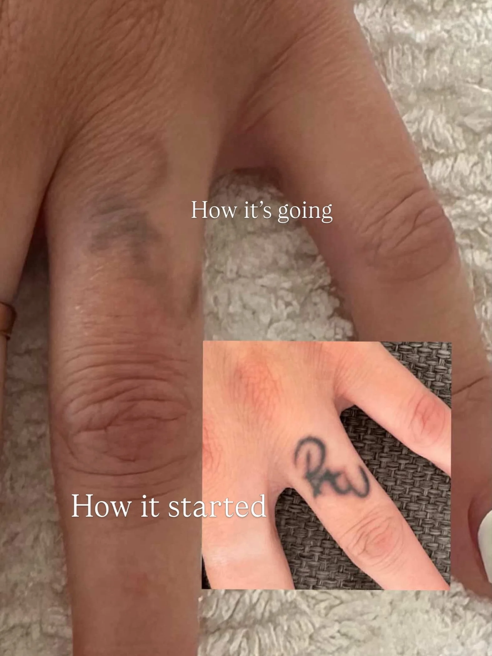 When this client enquired about laser tattoo removal, there were a few things working against it in terms of how fast the tattoo would break down in response to the laser. The tattoo had 2 x layers of ink in it due to requiring a touch up, meaning th