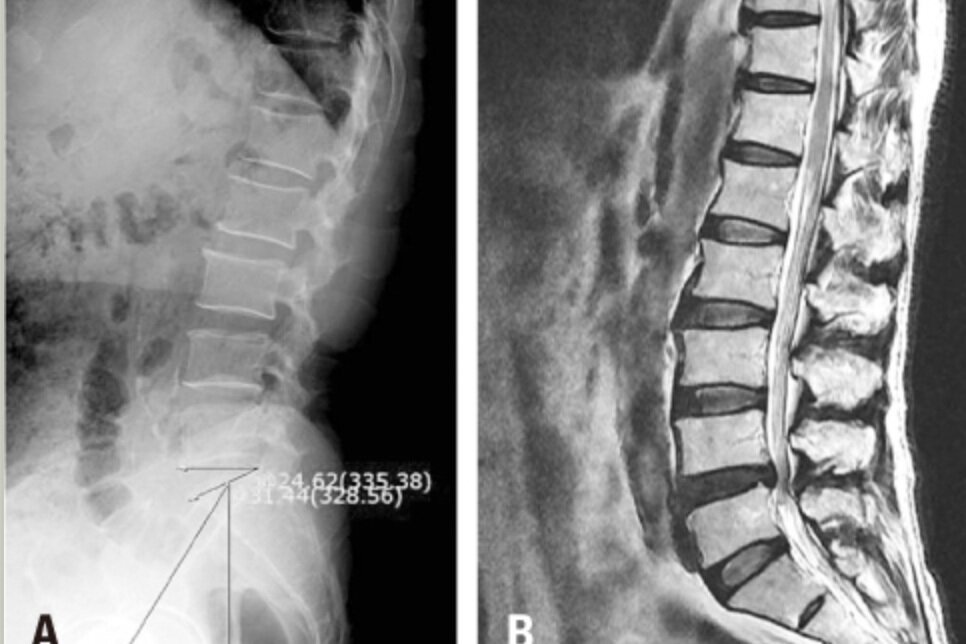 Understanding Spinal Arthritis: Latest Evidence on Pathology and Treatment