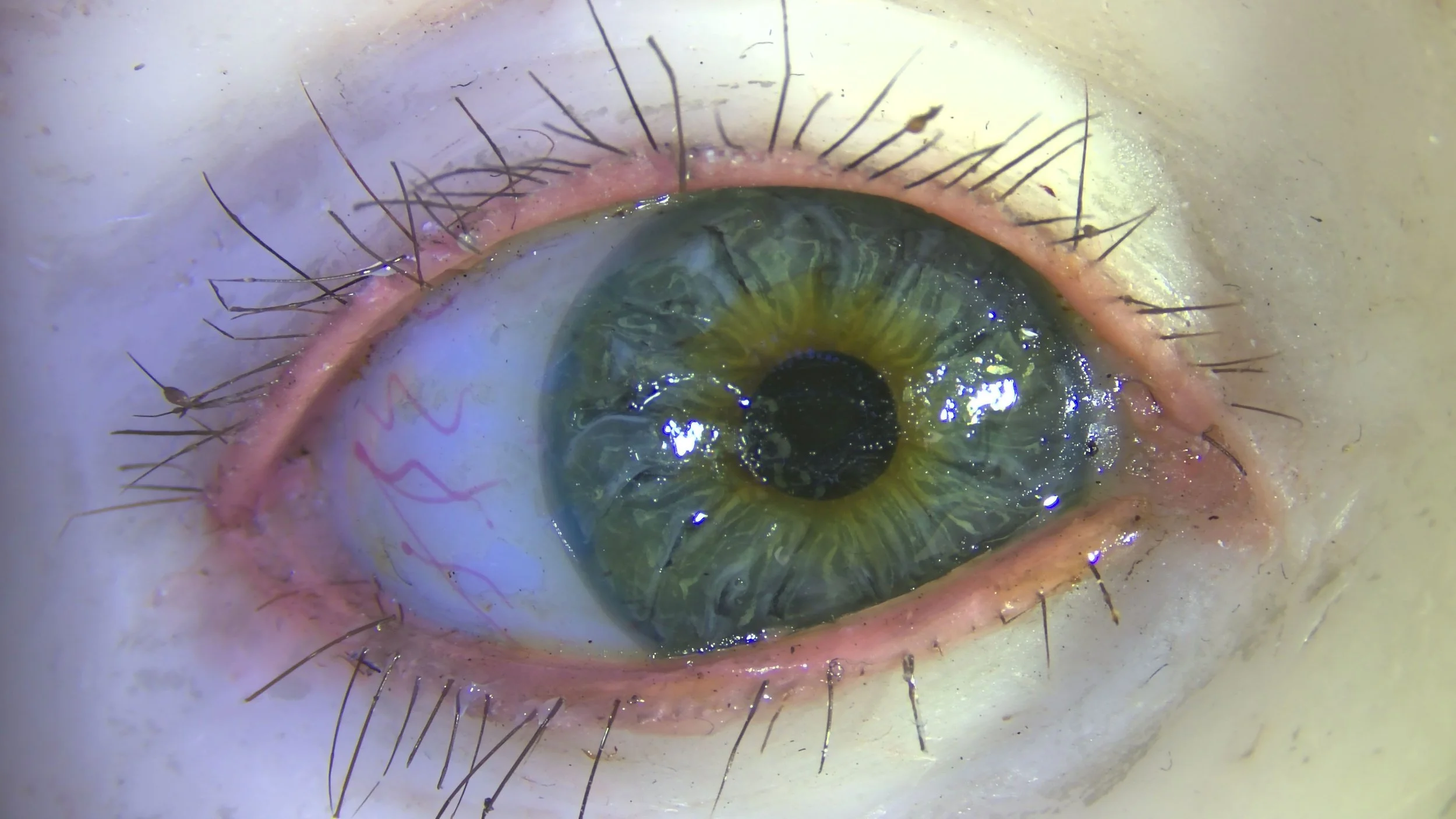 Fig. 7 Original and replacement meyelashes, during, normal light