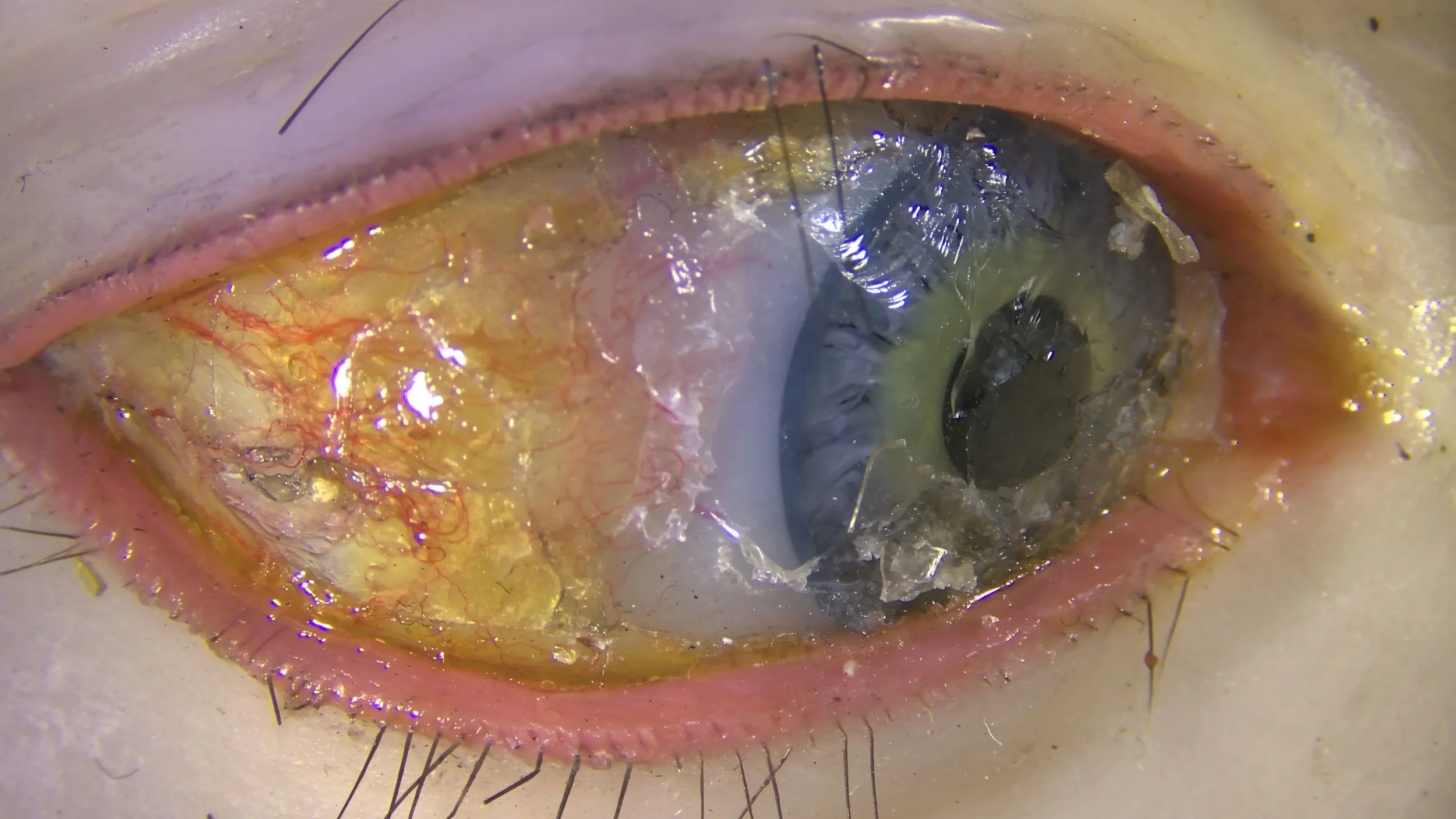 Fig. 9d during treatment, normal light