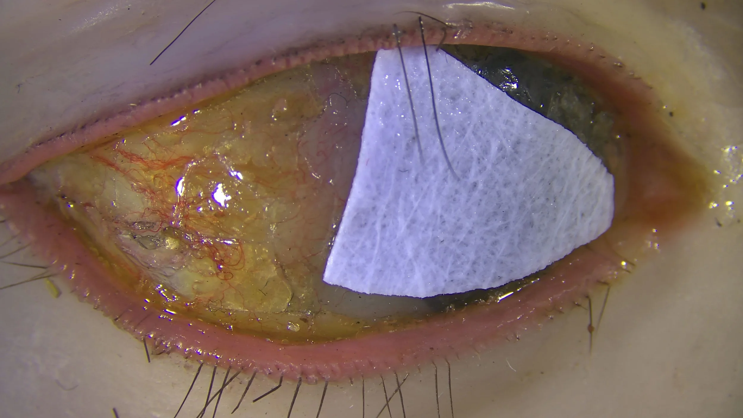 Fig. 9b during treatment, normal light
