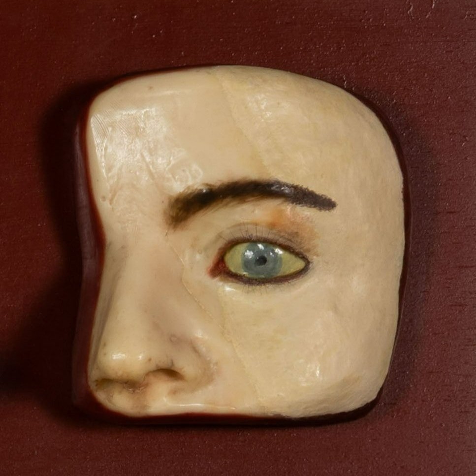 Fig 11c after treatment, normal light