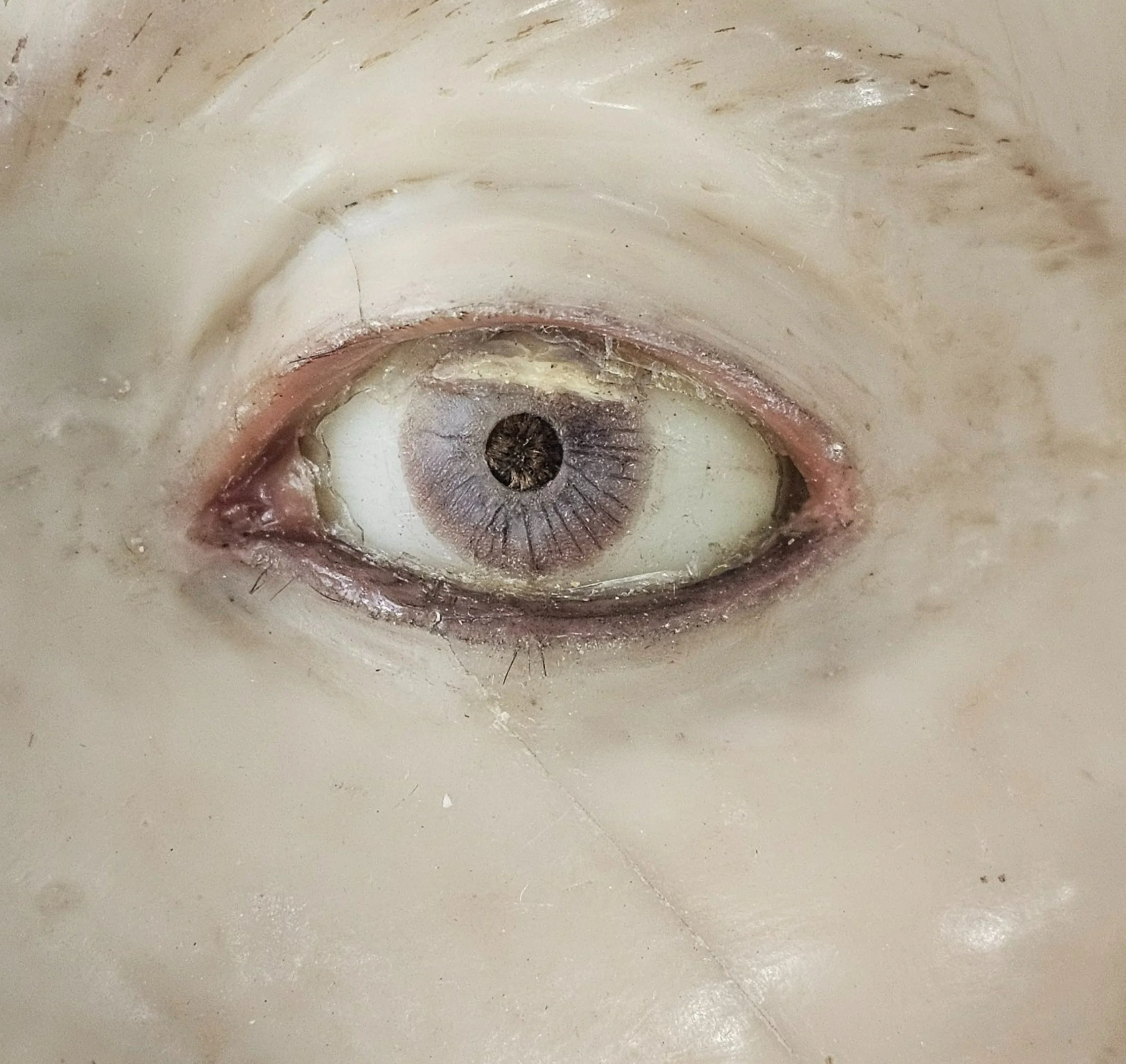Fig. 10c during treatment, original cornea removed