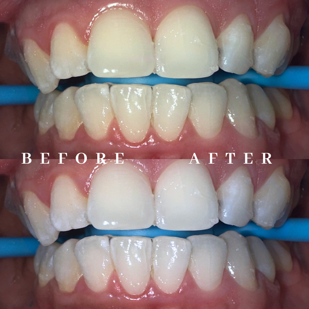 Close-up of a person's teeth, showing a before and after comparison of dental cleaning or whitening.