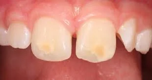 Understanding Enamel Hypomineralisation: Causes, Symptoms, and Treatment