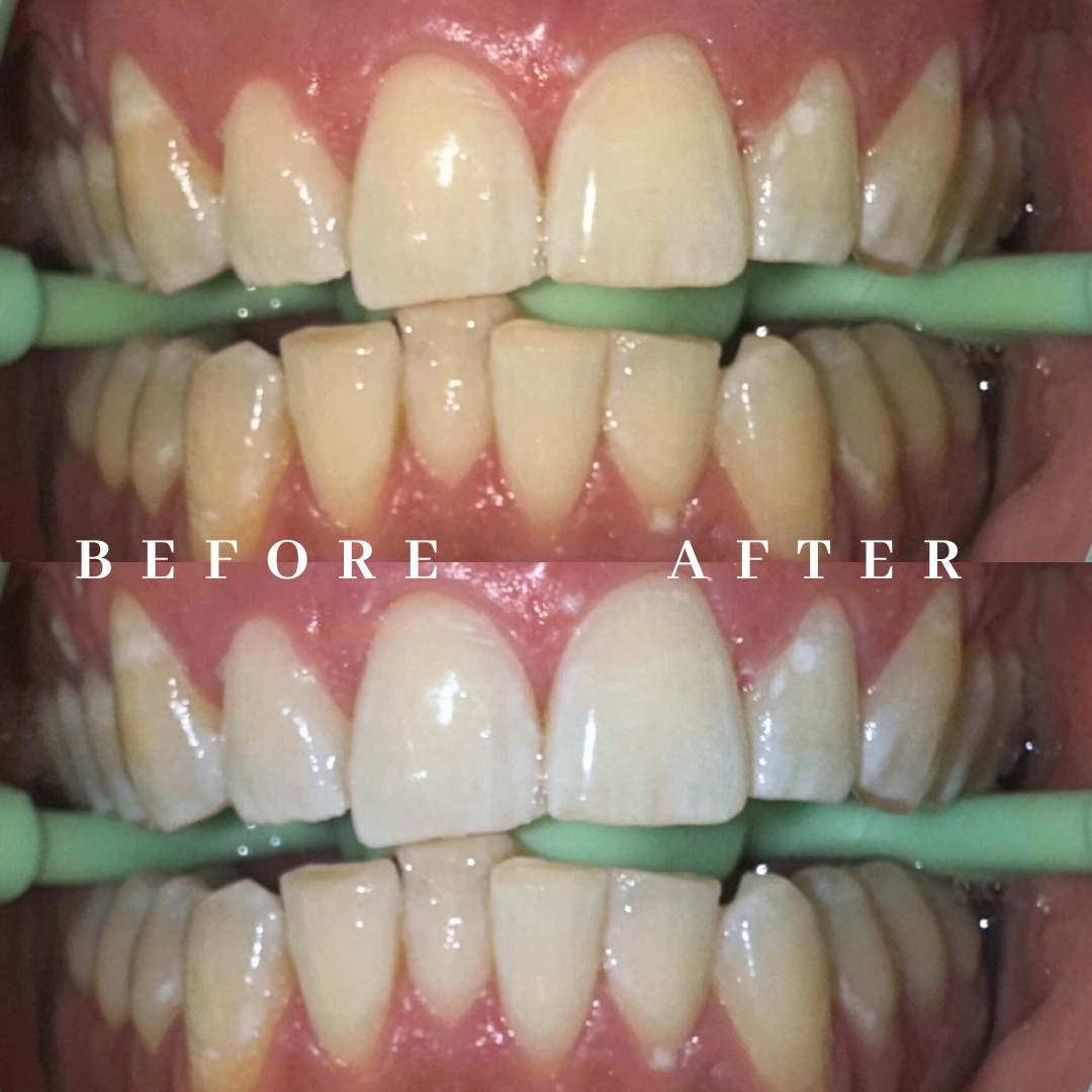 Comparison of teeth before and after whitening treatment, with a green tool between the teeth in each image.