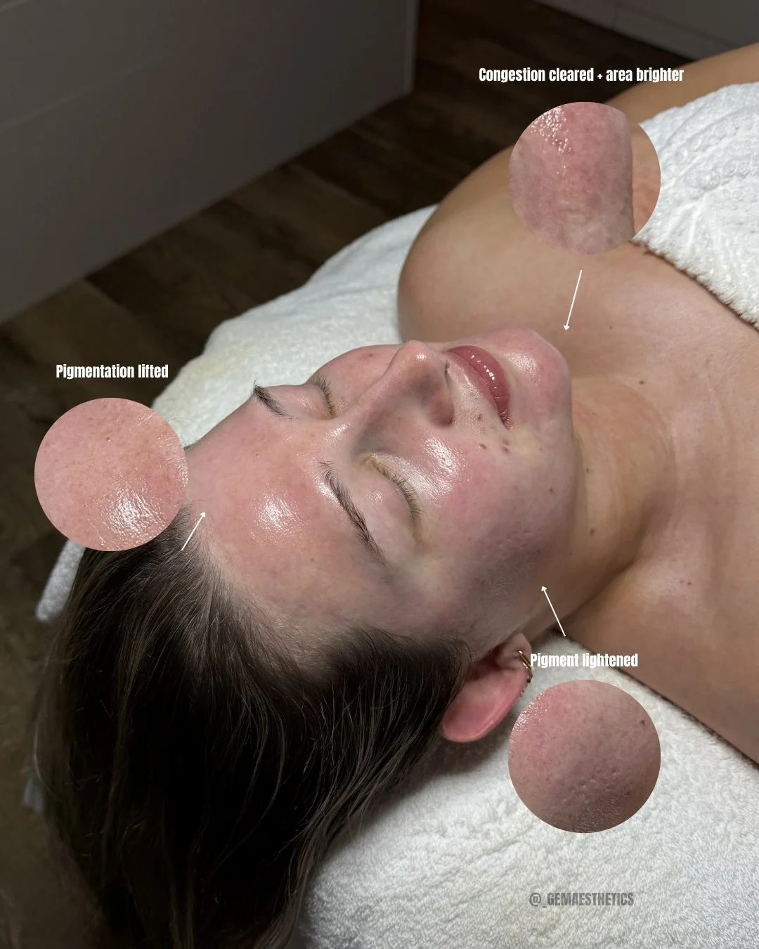 &ldquo;Facials don&rsquo;t do anything for your skin&rdquo; 

Well how do you explain these results then? 🪞✨ 

Facials create real, visible changes in your skin over time by deeply cleansing, exfoliating, and increasing circulation to remove buildup