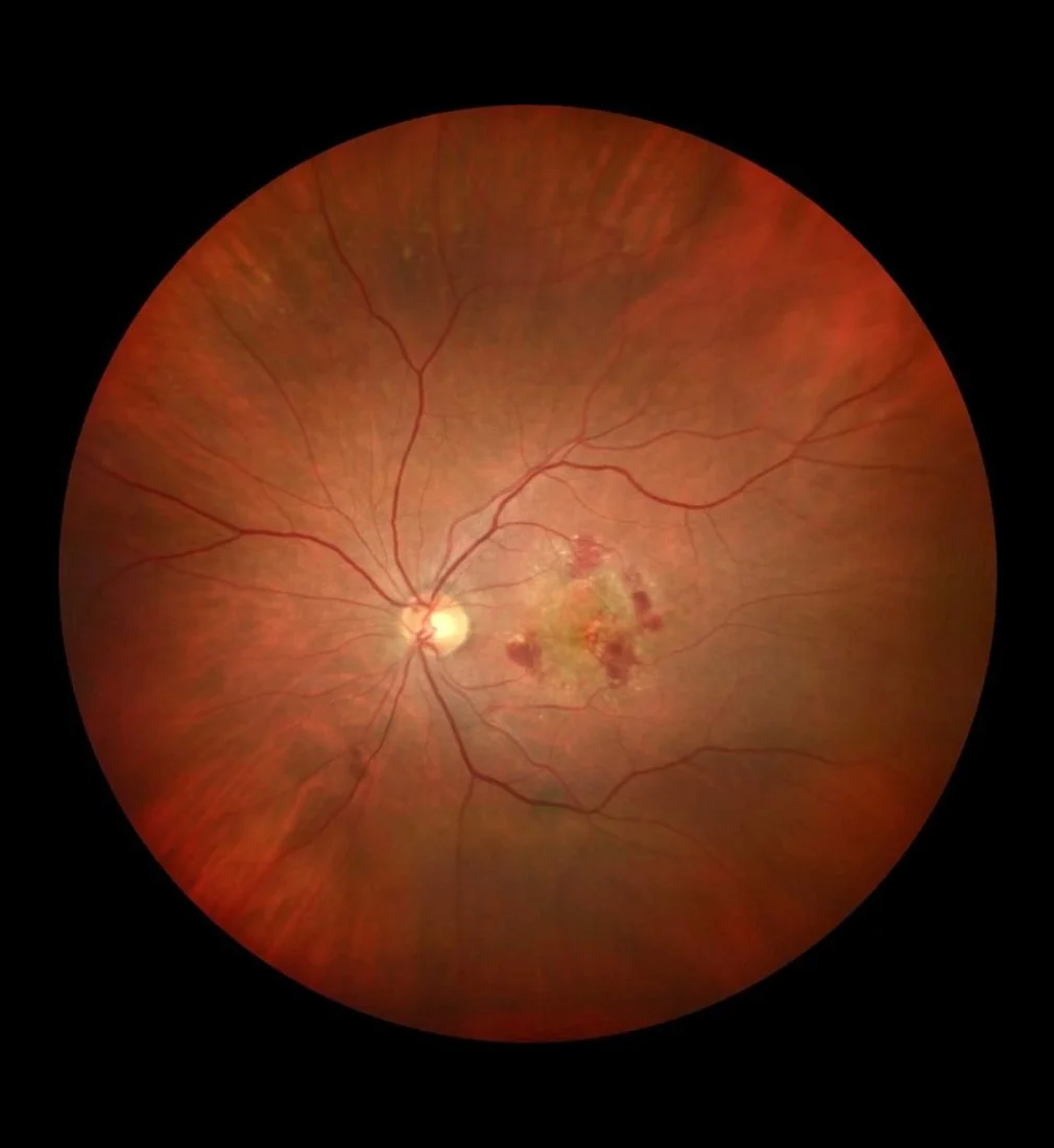 Macular Degeneration — Horta-Santini Eyecare
