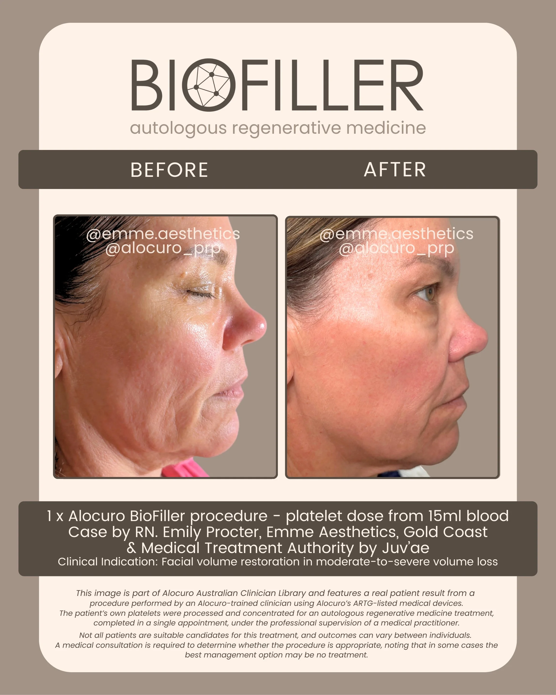 Sept 2026 Biofiller - B&A - Emme A.jpg