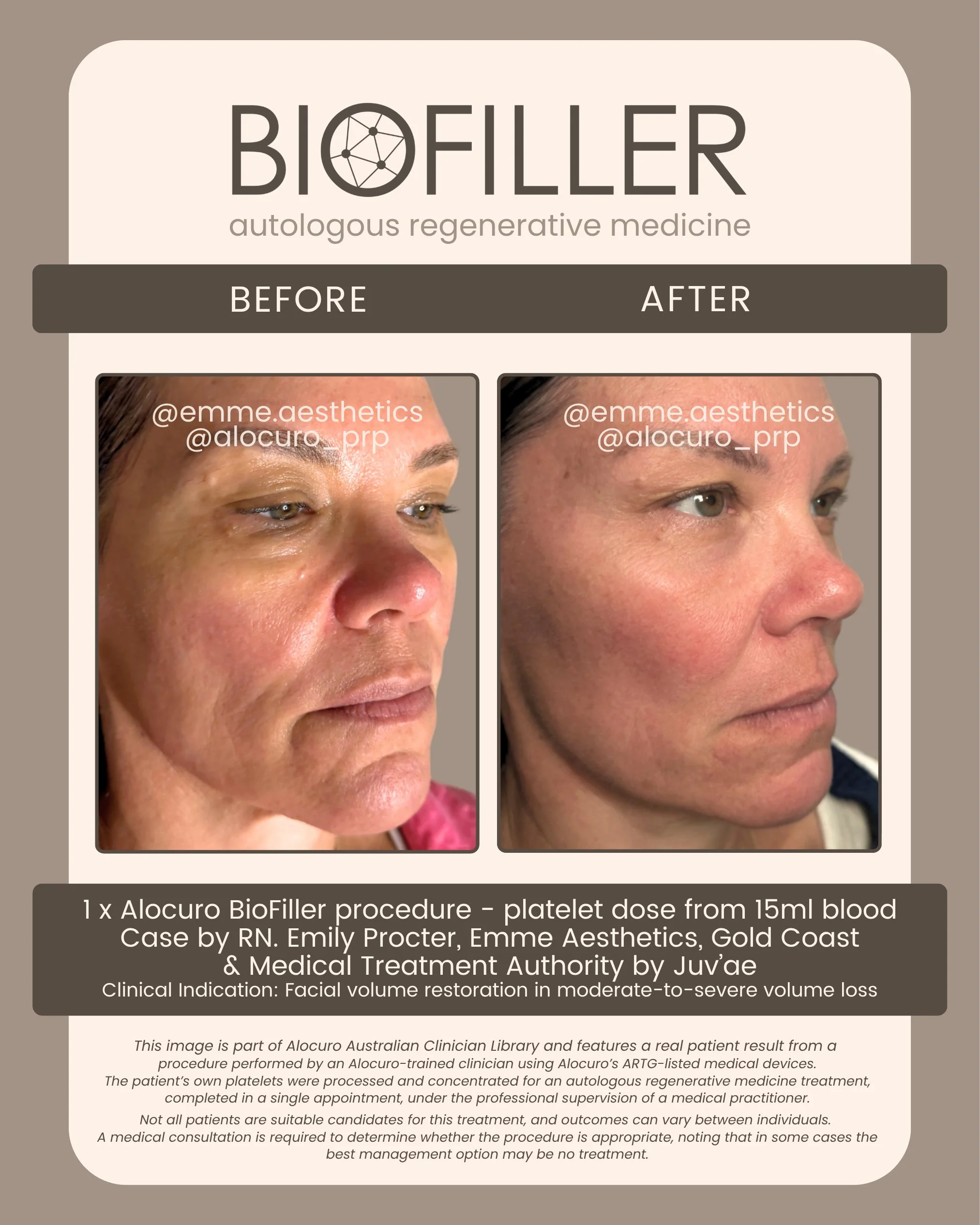 Sept 2026 Biofiller - B&A - Emme A2.jpg