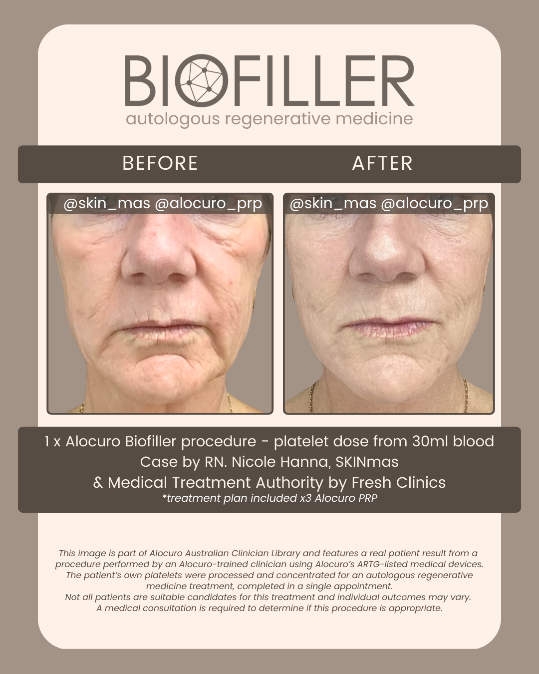 PATIENT RESULTS — Biofiller