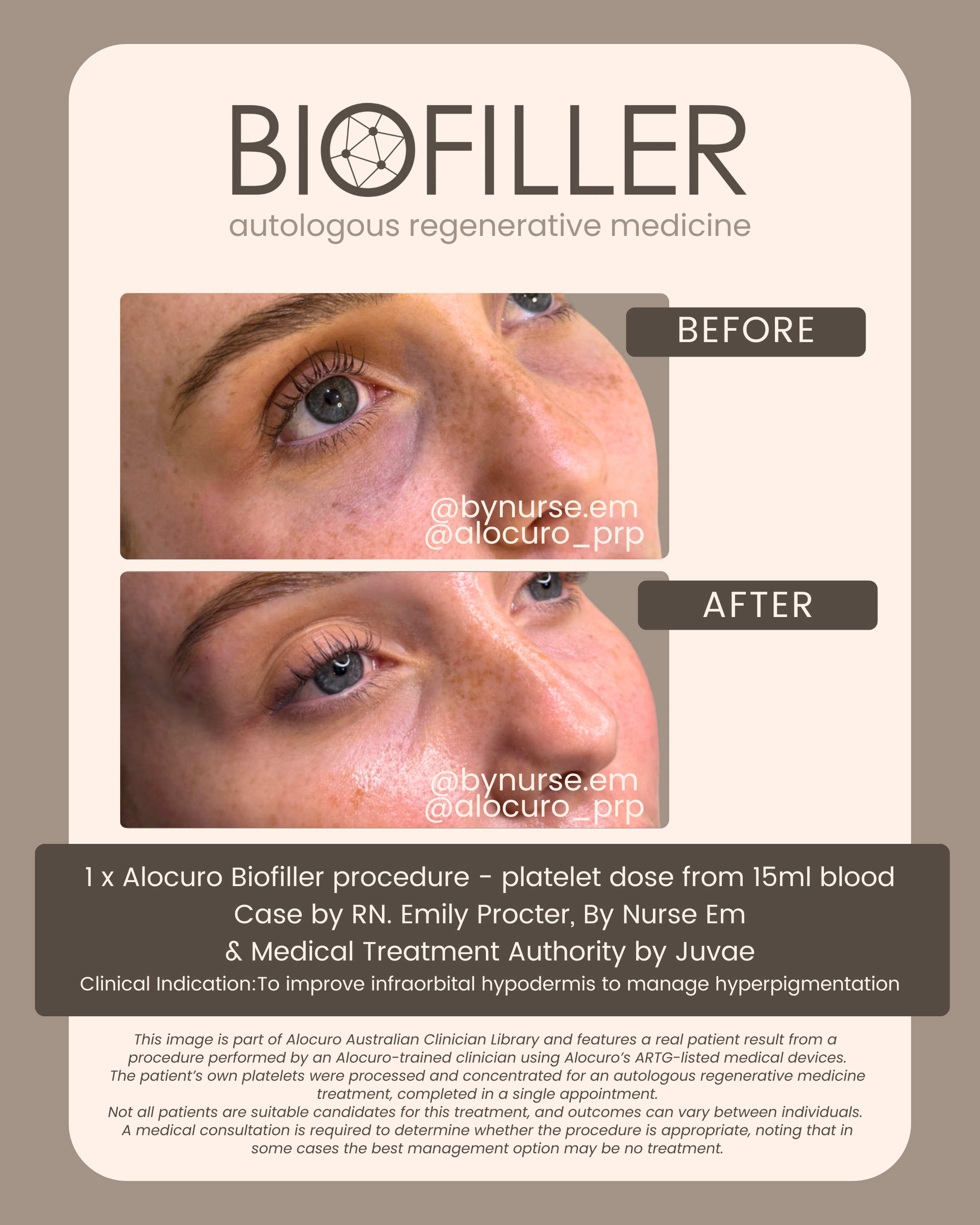 BioFiller natural rejuvenation undereye