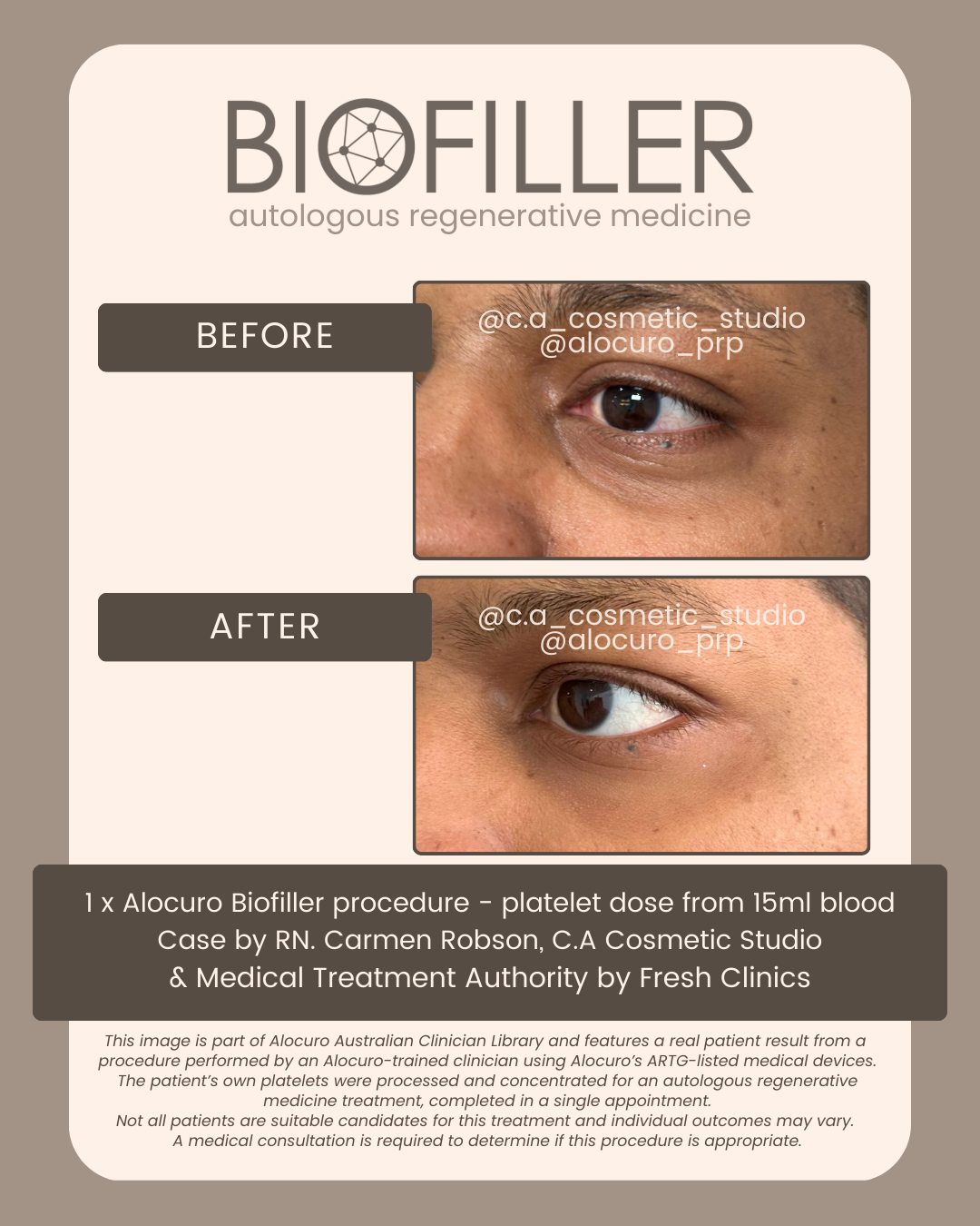 PATIENT RESULTS — Biofiller
