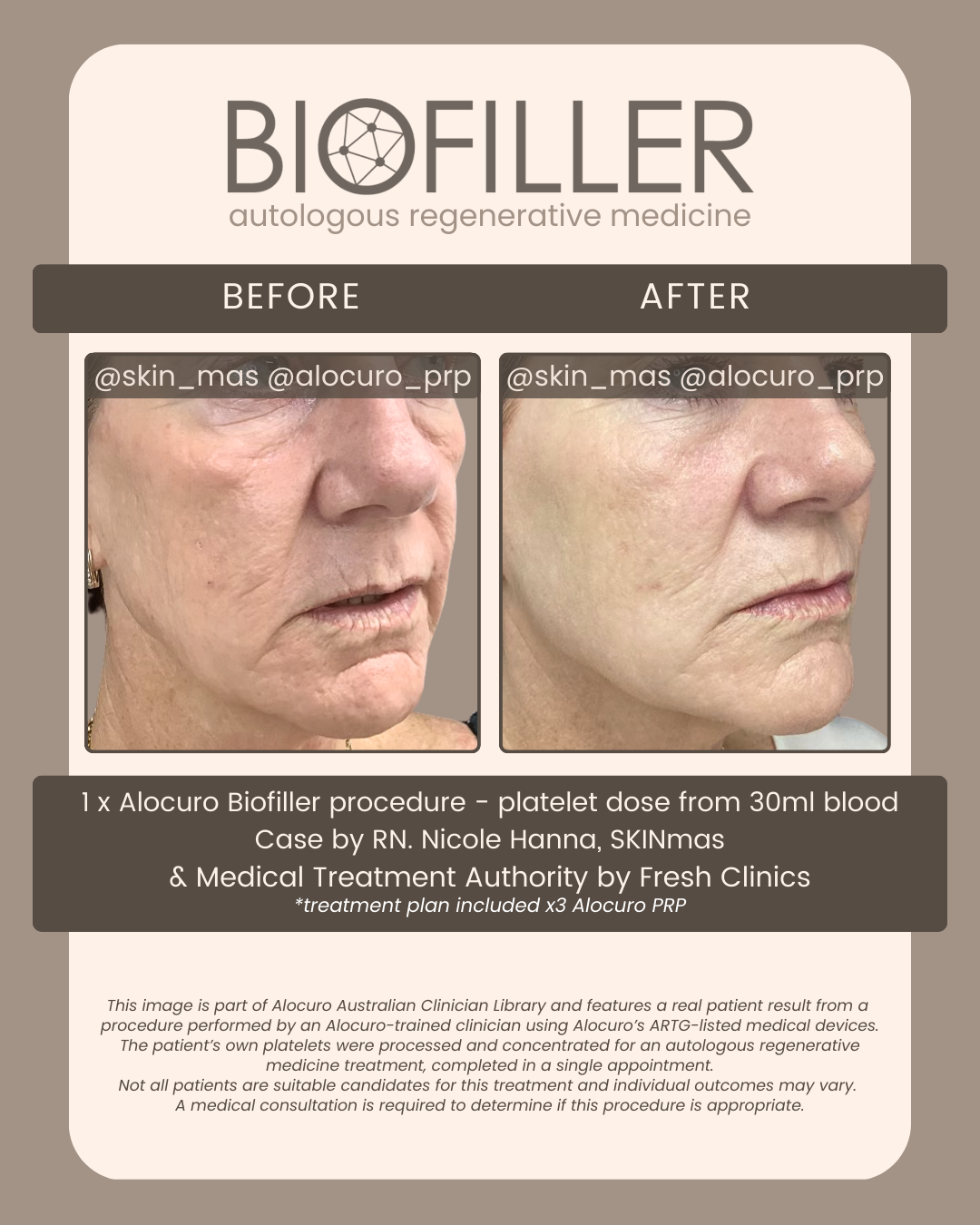 HP Final Biofiller - B&A - Nicole Hanna 2025 Ab.png