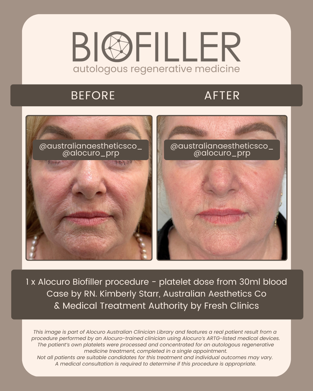 PATIENT RESULTS — Biofiller