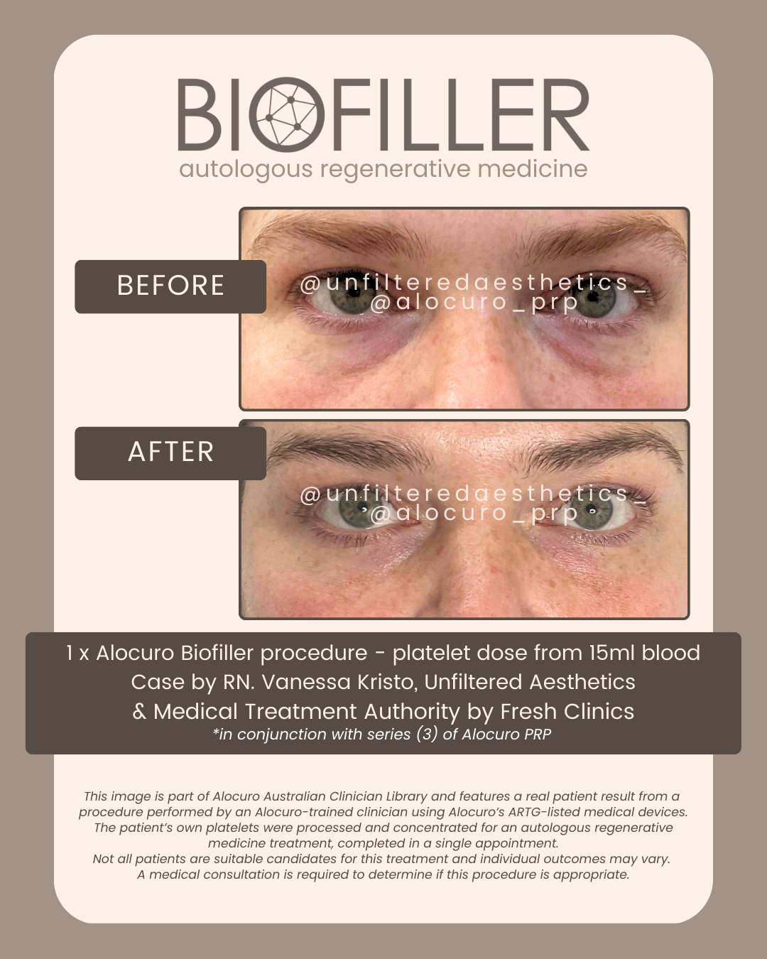 HP Final - Biofiller - Vanessa Kristo 2025 A.png
