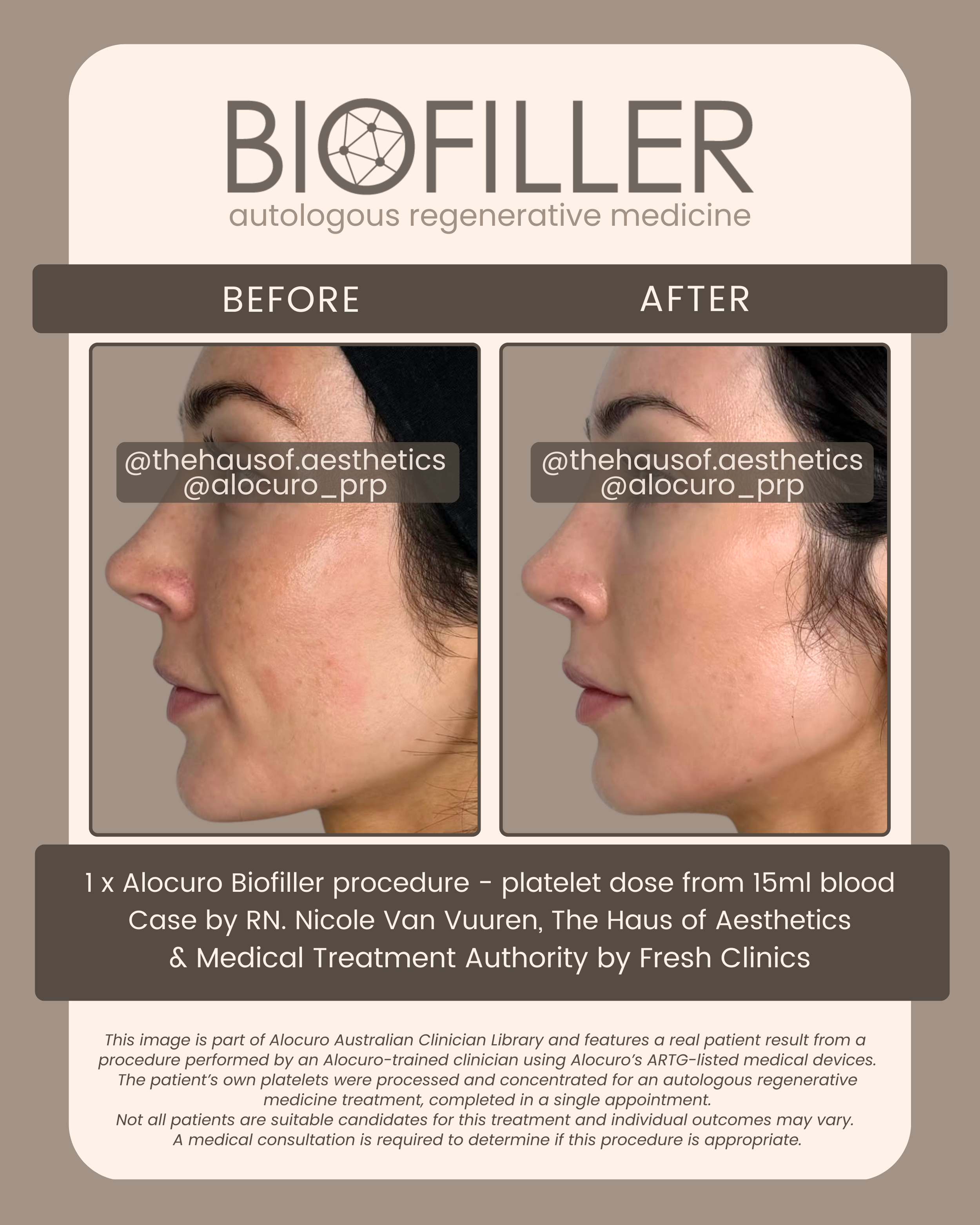 PATIENT RESULTS — Biofiller