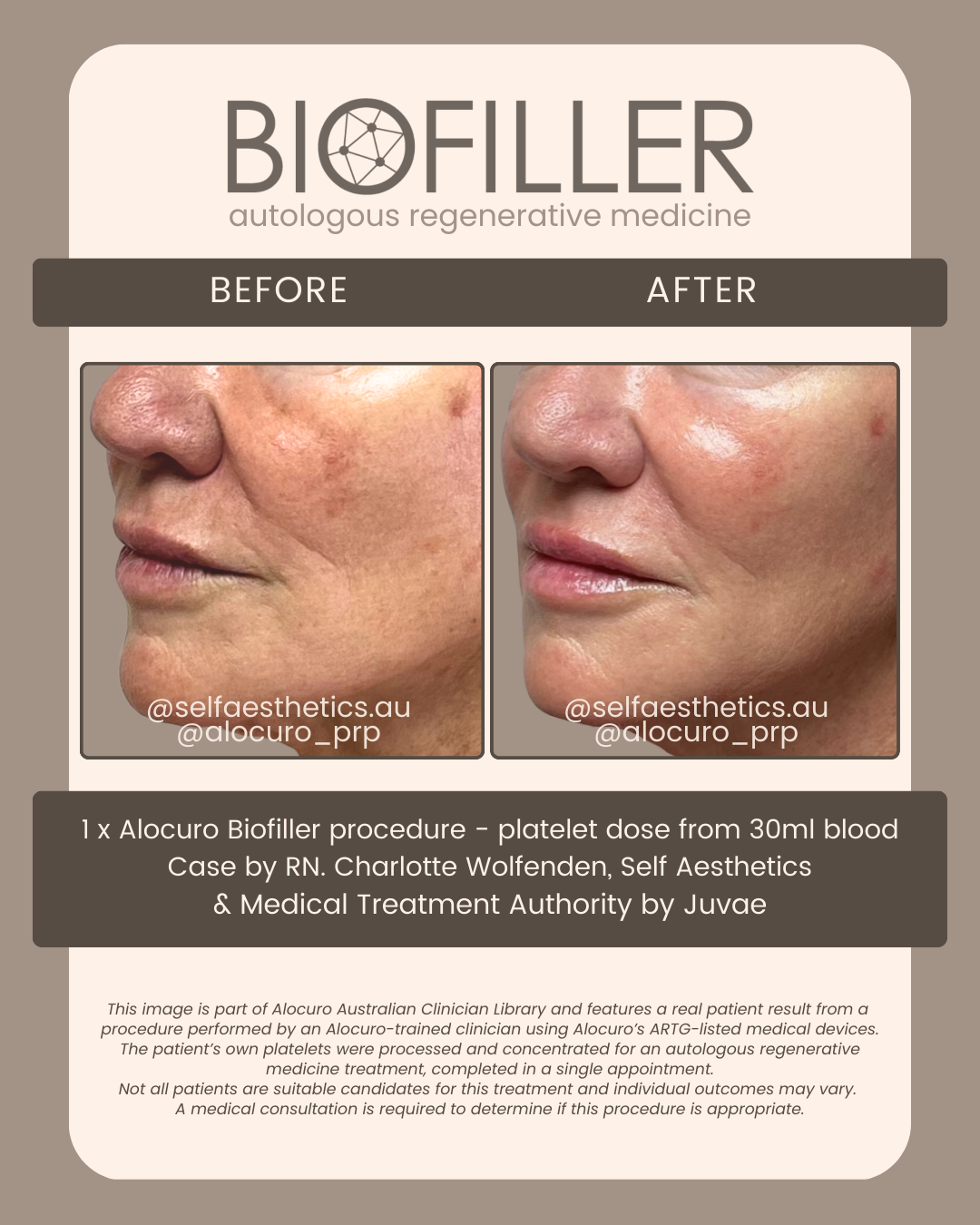 PATIENT RESULTS — Biofiller