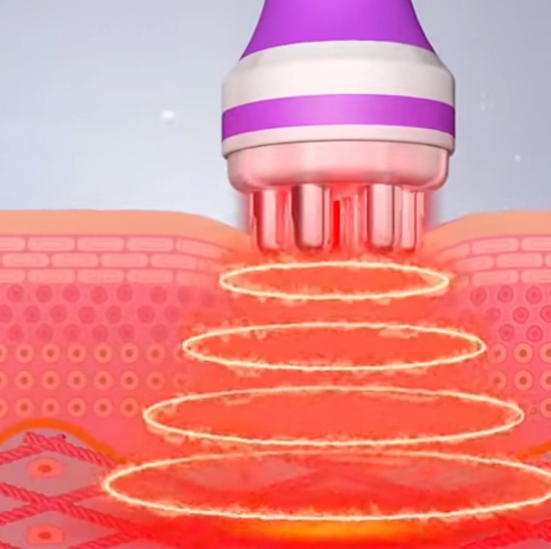 How Radiofrequency (RF) Treatments Tighten Skin: The Science Explained