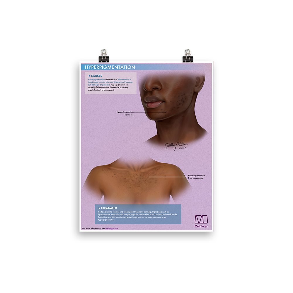 hyperpigmentation-thumbnail.jpg