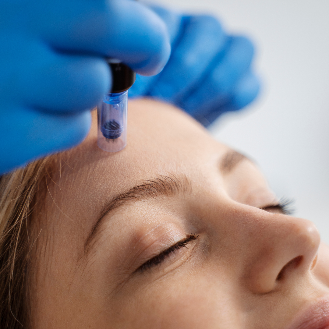 Close-up of a woman receiving a cosmetic treatment on her forehead using a small syringe, wearing a blue glove.