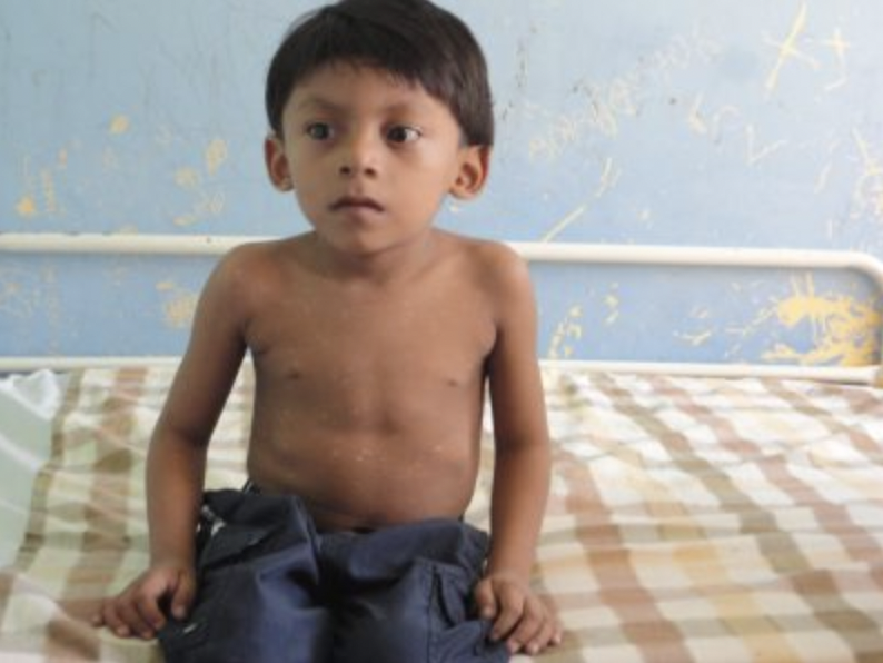  Four-year-old Nicaraguan patient suffering from tuberculosis of the spine. 
