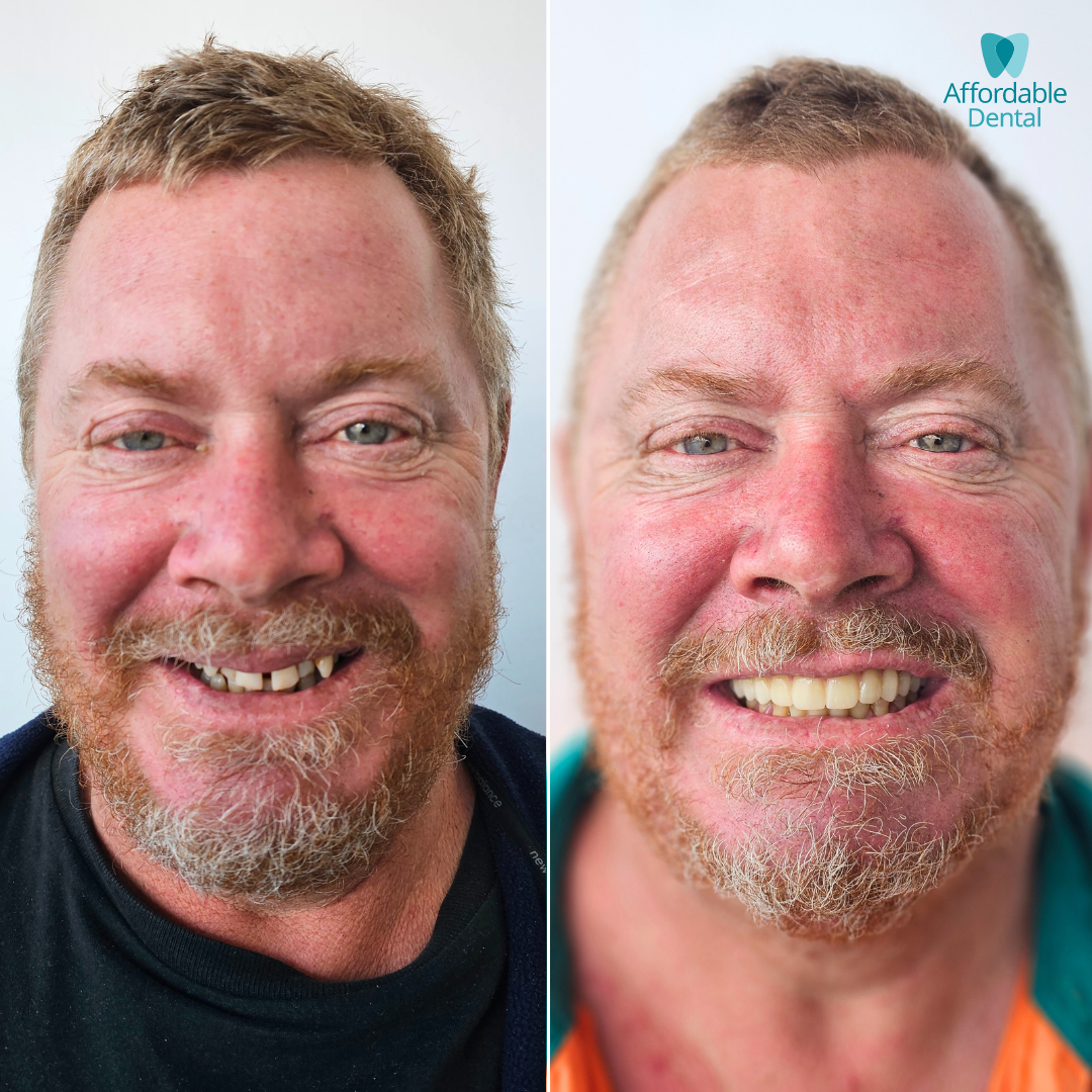 Affordable Dental Before & After Updated (3).png
