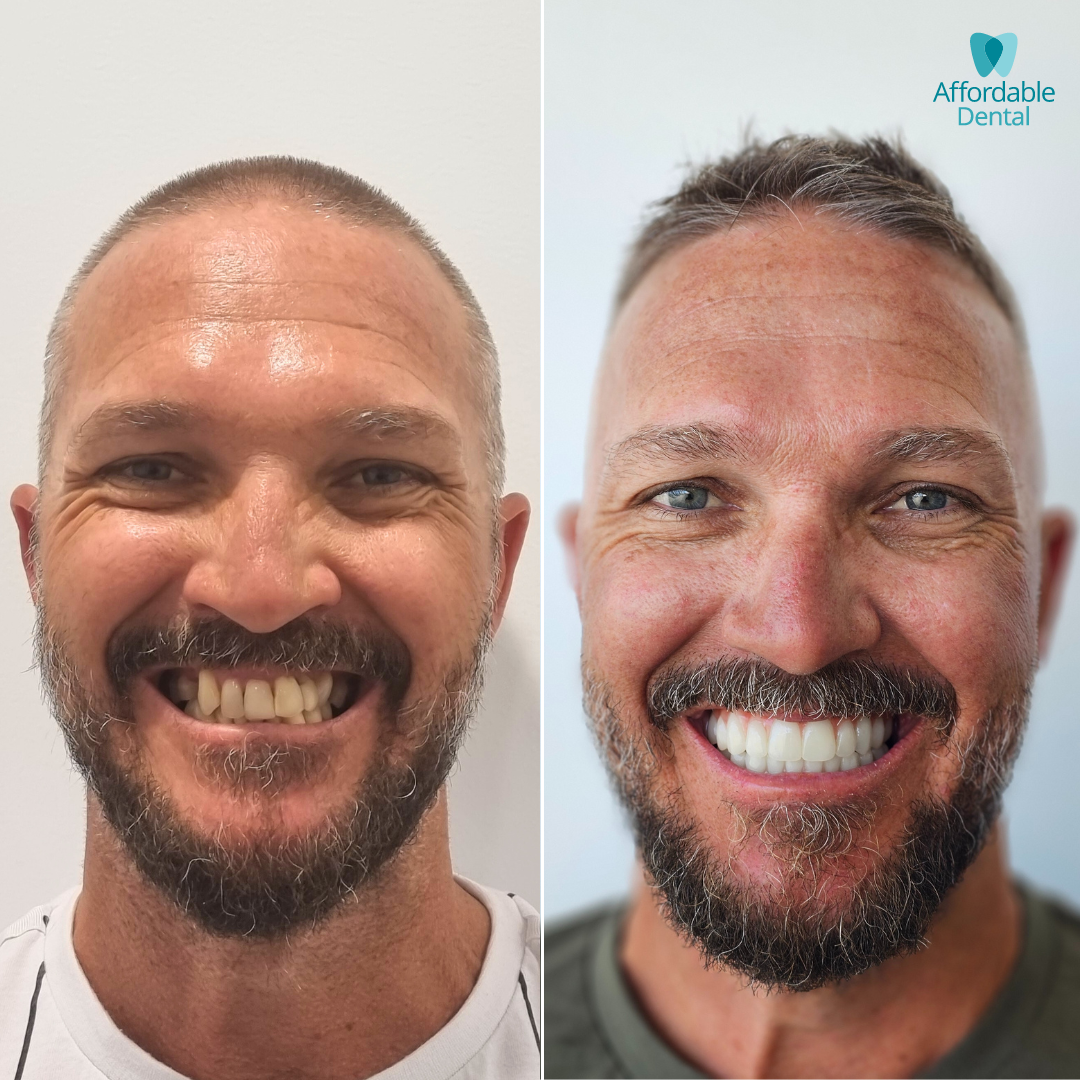 Affordable Dental Before & After Updated (2).png