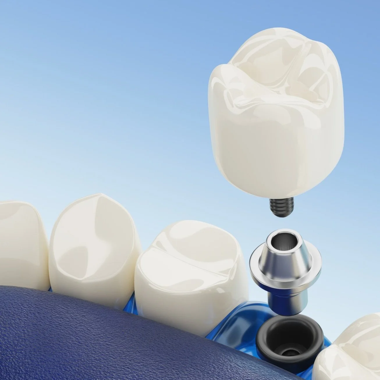 Affordable dental implants