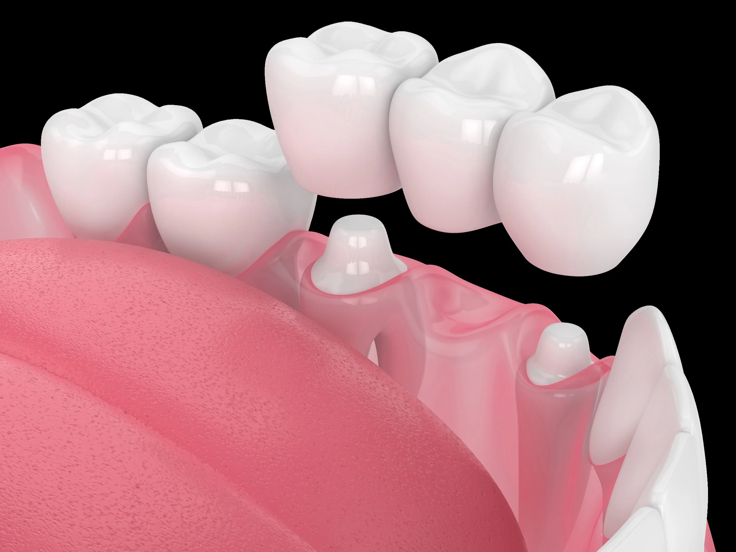 Dental Crown Treatment Tooth Crown Dentist Affordable Dental