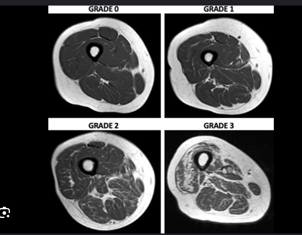 MRI images showing muscle degeneration in stages from Grade 0 to Grade 3.
