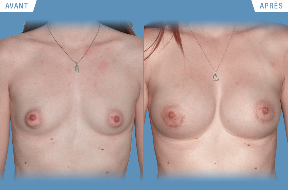 Augmentation-mammaire-BER-Ang_Bleu face.png