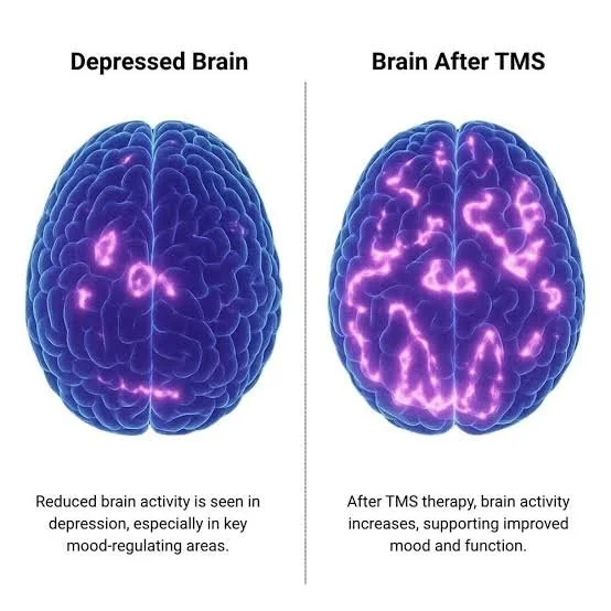 Transcranial Magnetic Stimulation in Dallas, TX