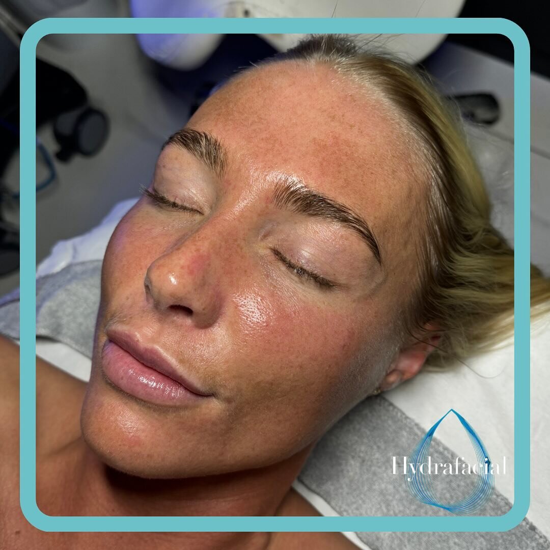 𝐓𝐡𝐞 𝐇𝐲𝐝𝐫𝐚𝐟𝐚𝐜𝐢𝐚𝐥 𝐠𝐥𝐨𝐰 ✨
Our lovely client has regular Hydrafacials every 4 weeks (as recommended) to keep her skin super healthy, hydrated and nourished. 
This was after our Holmes of Beauty tailored Express Hydrafacial (45 minute) t