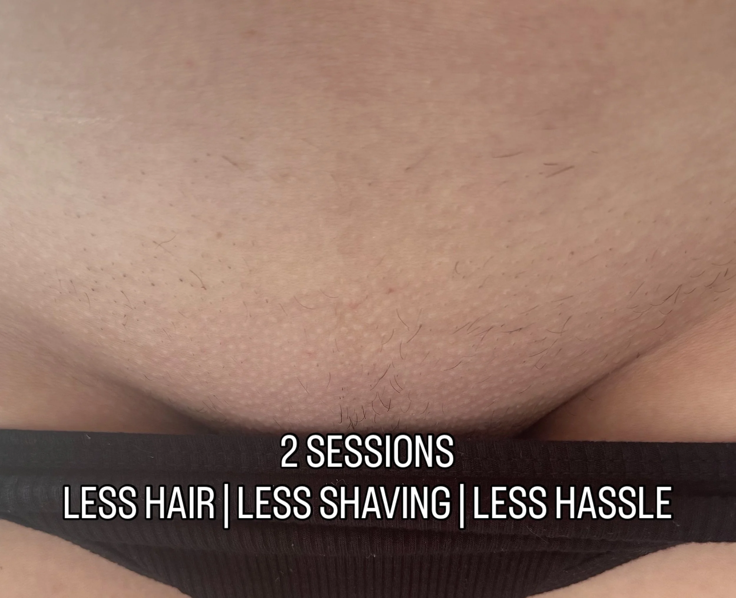 Hollywood Laser Hair Removal Bournemouth, Poole, Christchurch & Dorset | Real Results After Just 2 Sessions
