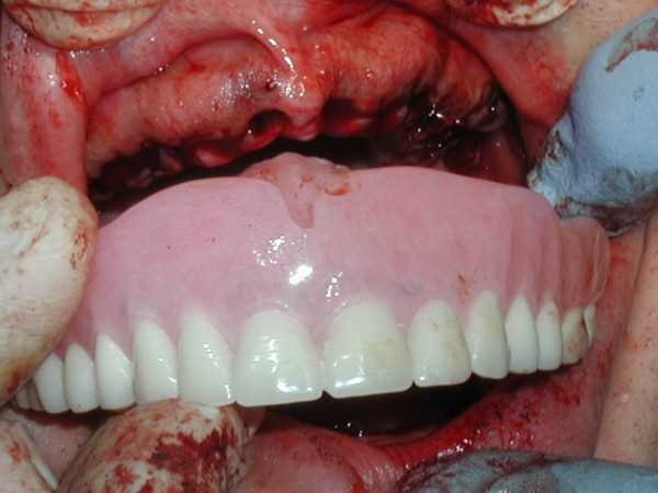Immediate Full Upper Denture
