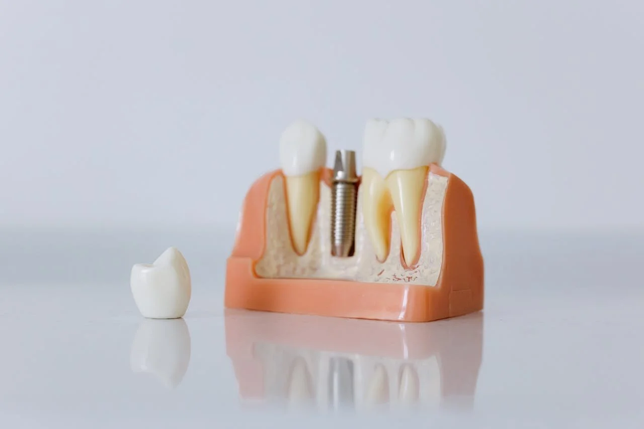 Do Dental Implants Hurt?