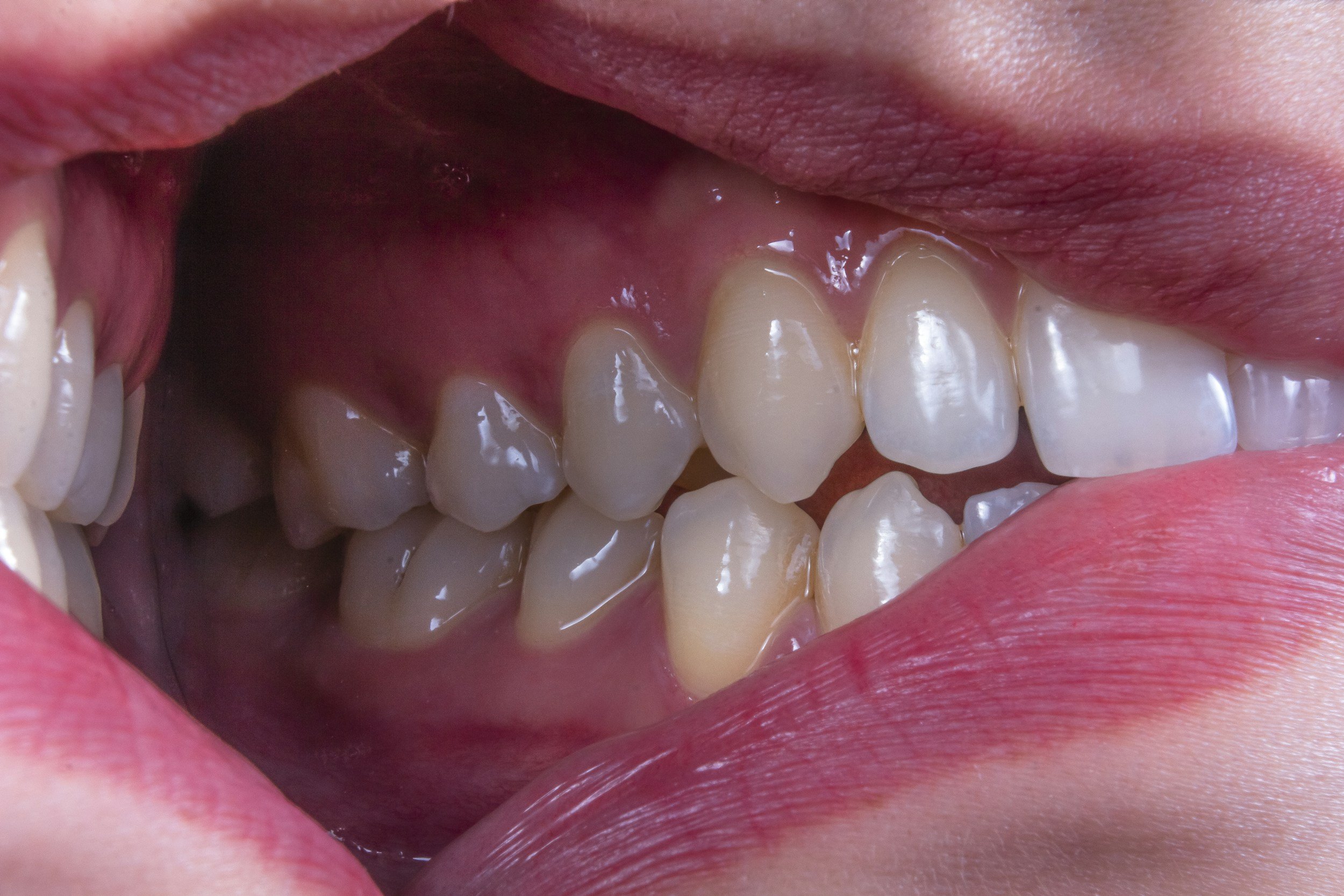 What Is a Gum Boil? Causes, Treatments, and Risks