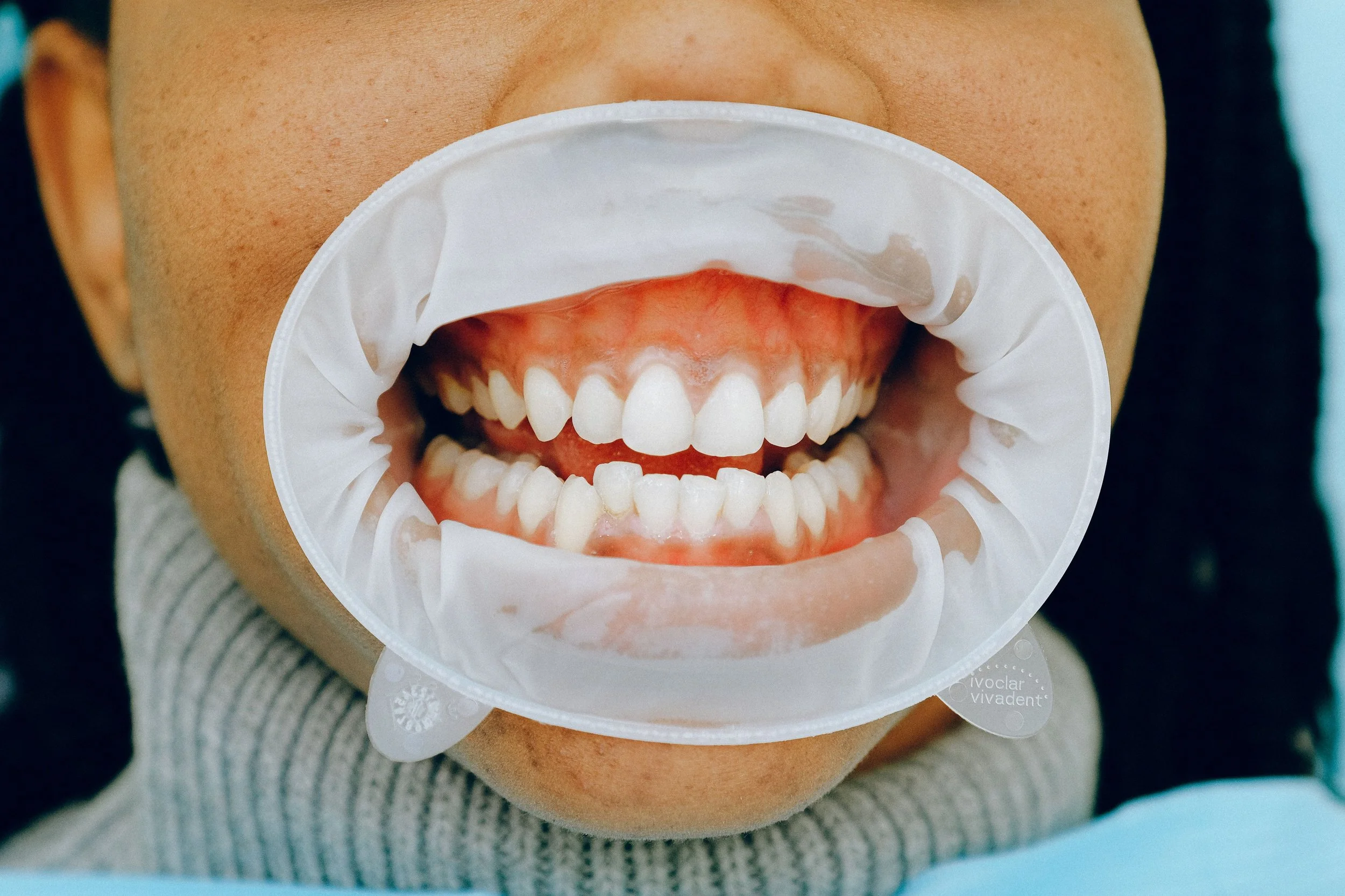 What Causes Bone Loss in Teeth?