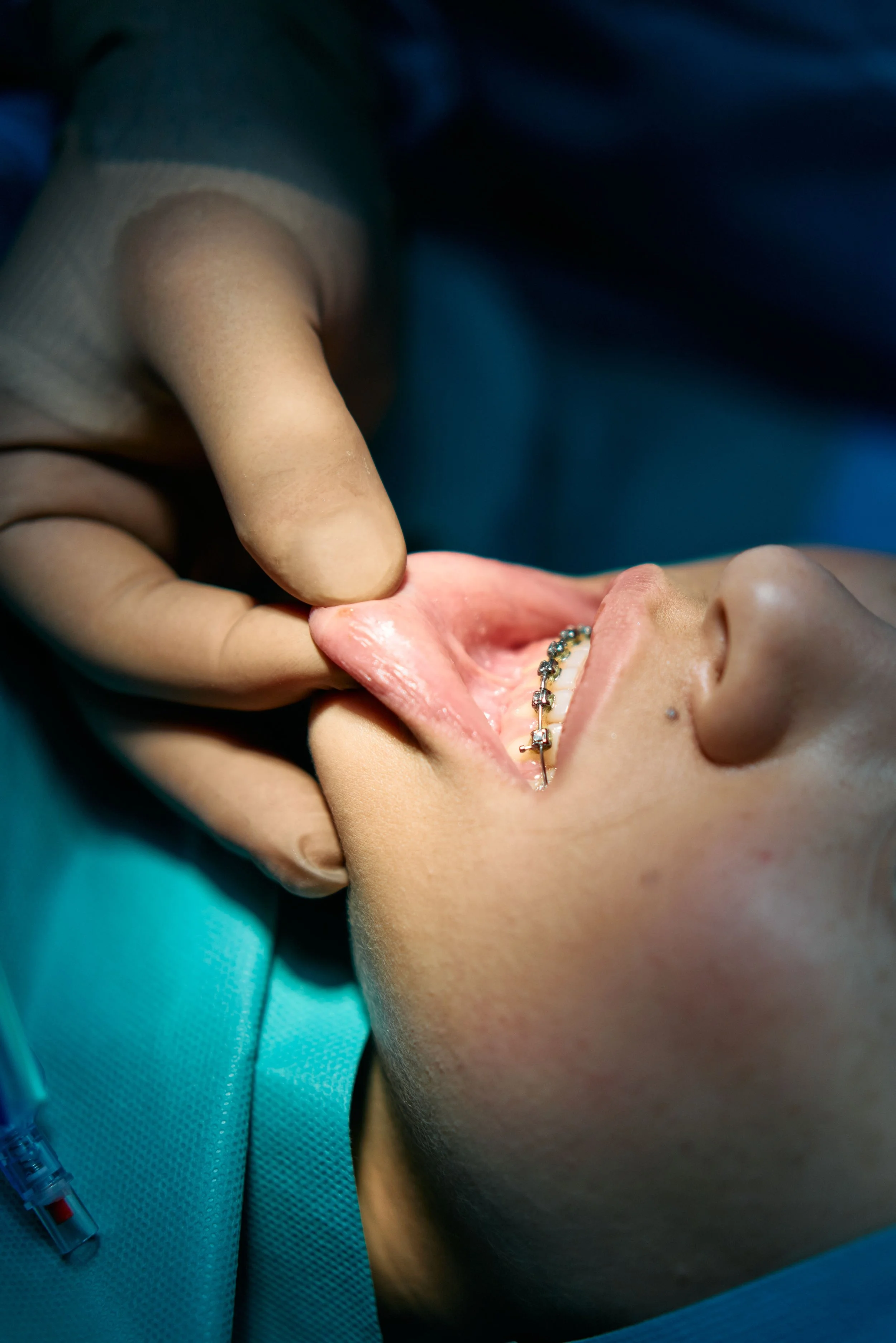 Oral Mucocele