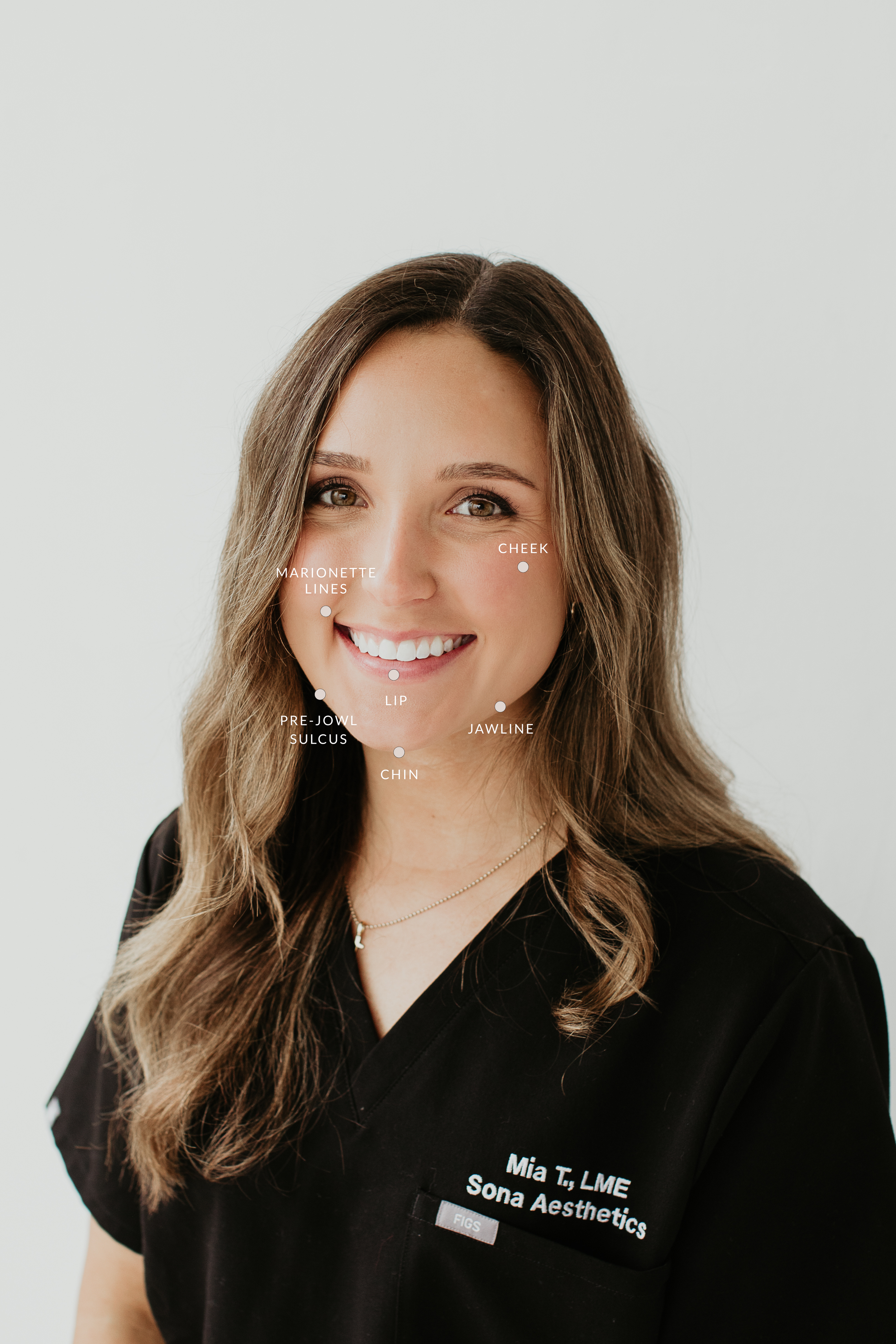 Dermal filler treatment areas diagram — Sona Medical Aesthetics Newcastle WA